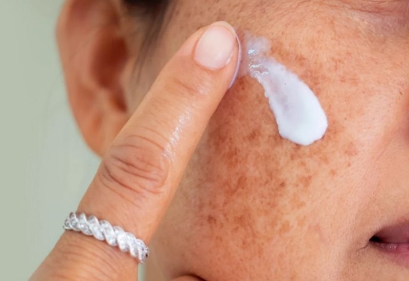 Pele-seca-por-causa-da-acne