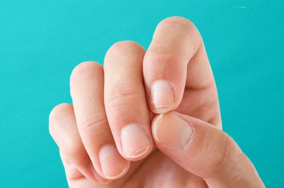 Receitas caseira para clarear as unhas amarela