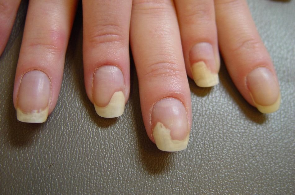 Deficiencia-em-vitaminas-e-minerais