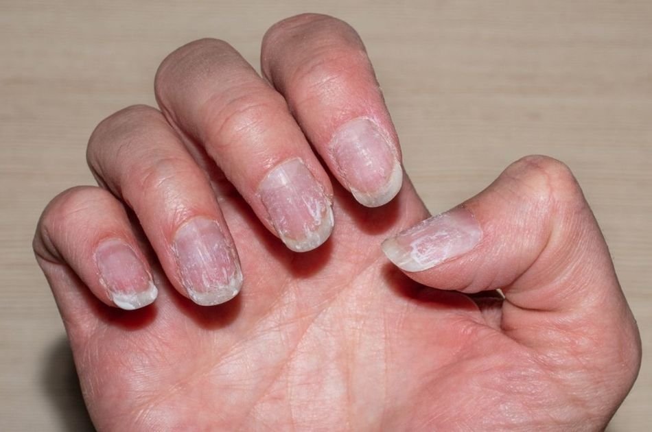 Riscos da esmaltação em gel e unhas artificiais no inverno