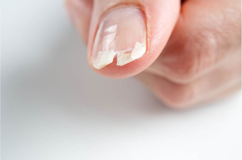 Diferenças entre as unhas quebradiças e doentes no inverno
