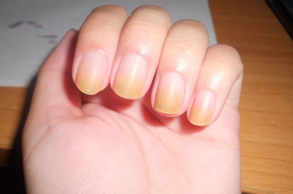 cuidados-com-as-unhas-amarela