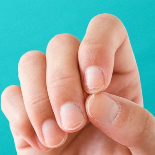 10 Alterações nas unhas podem ser sinais na saúde