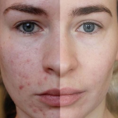 Alimentos que atrapalham e ajudam a evitar a acne