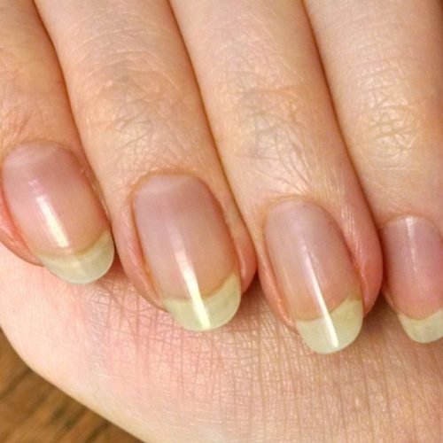 Como clarear as unhas amarelas em casa de forma segura