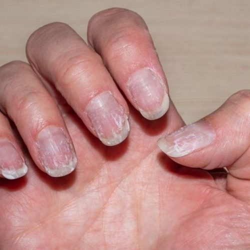 Dicas para recuperar unhas danificadas após esmaltação em gel